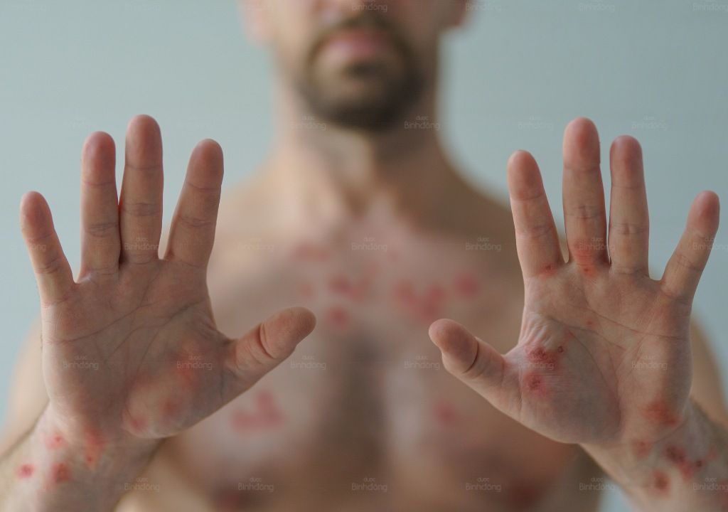 Ngứa lòng bàn tay, bàn chân là bị gì?