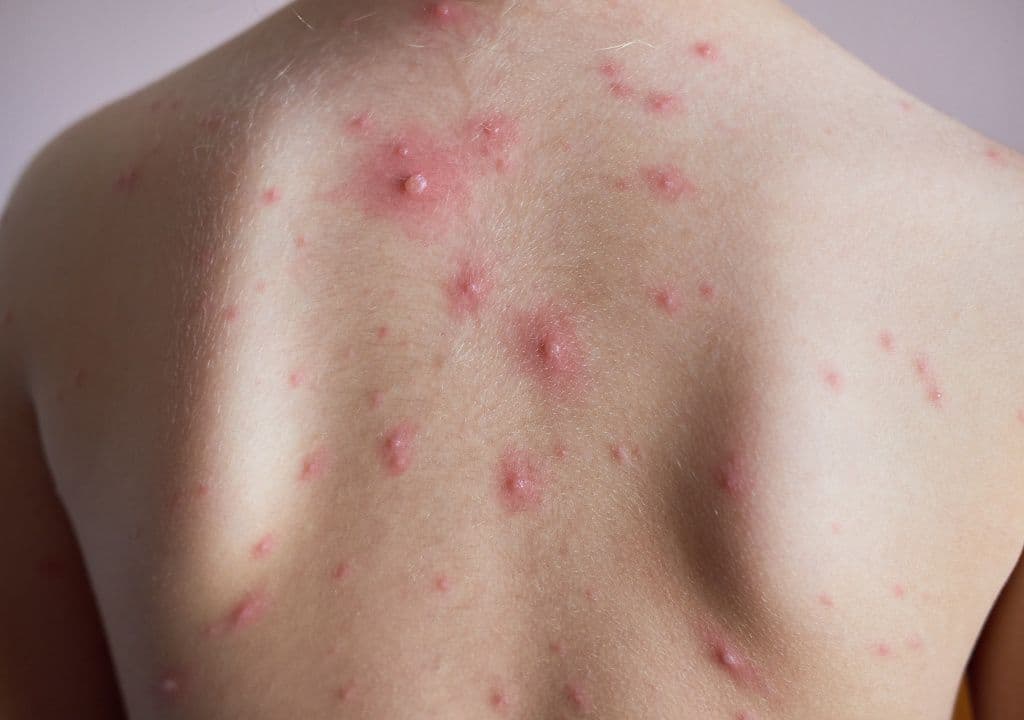 Phải làm gì khi bị nóng trong người nổi mụn? Giải pháp toàn diện cho bạn